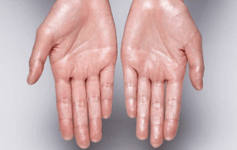 Гарын алганы хэт хөлрөлт зогсоох